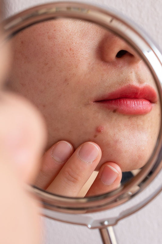 Stop Trying to Outsmart Your Body: The Key to Clear Skin Goes Beyond Skincare