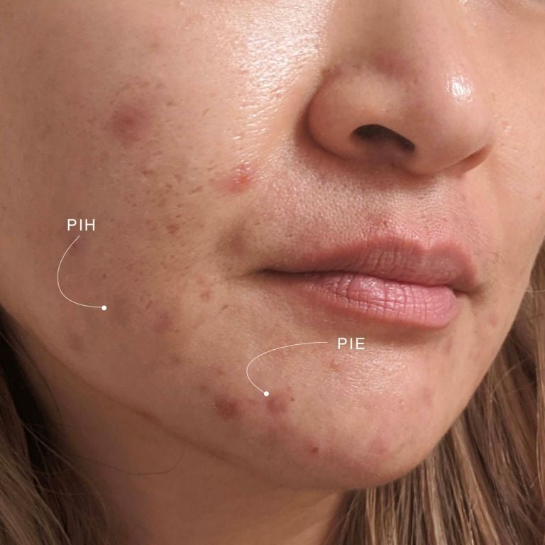 Achieving Clear Skin: How to Address Post-Inflammatory Erythema (PIE)